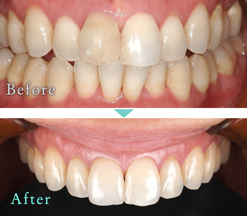 セラミック治療の症例10