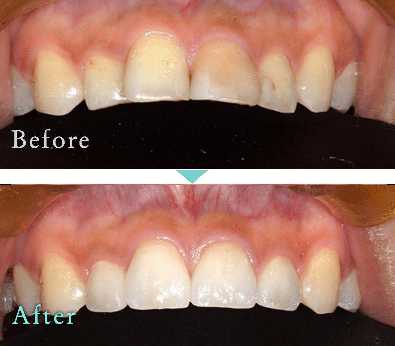 セラミック治療の症例12