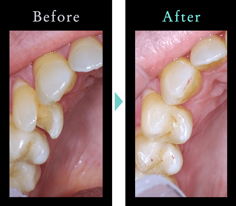 セラミック治療の症例1