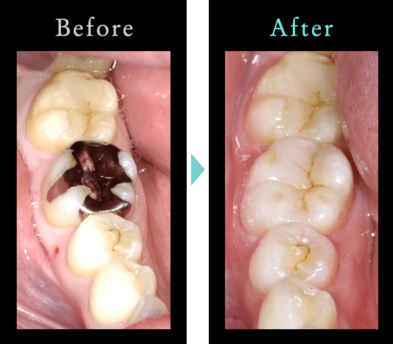 セラミック治療の症例6