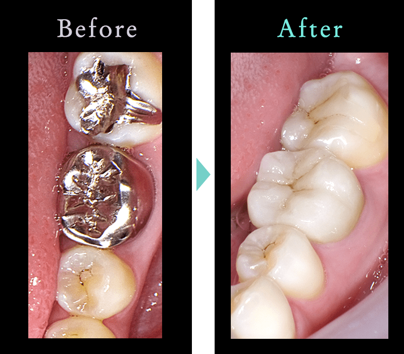 セラミック治療の症例7
