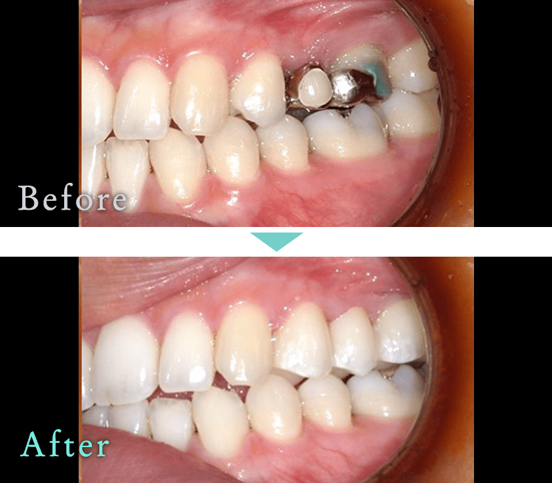 セラミック治療の症例9
