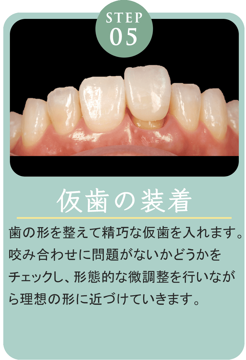 仮歯装着