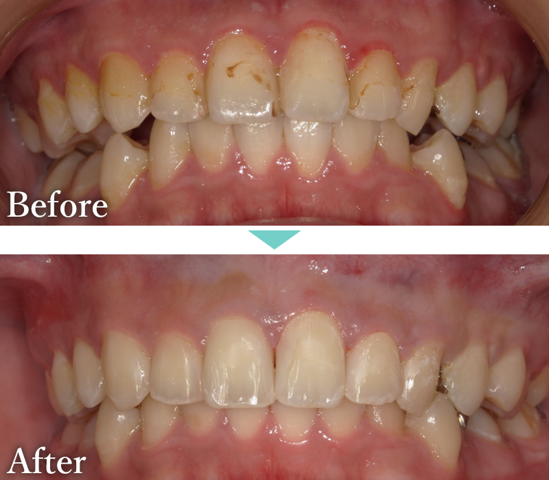 歯周病治療の症例1