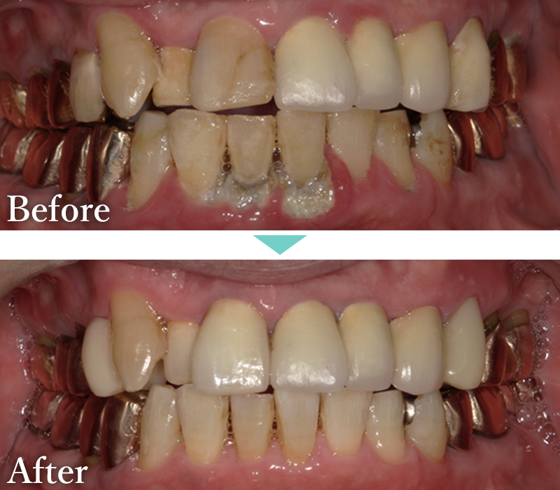 歯周病治療の症例2