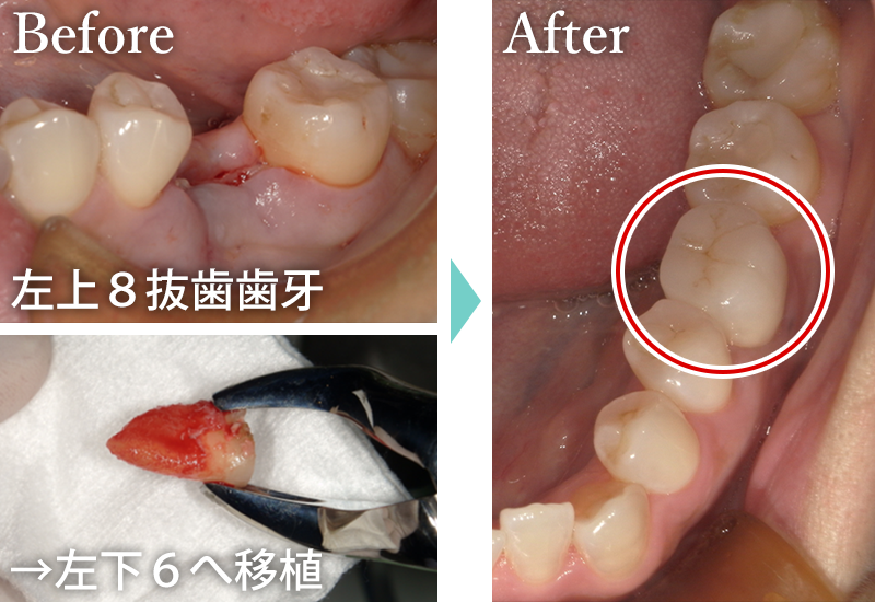 自家歯牙移植の症例