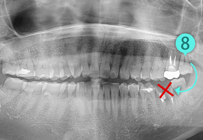 自家歯牙移植の症例2