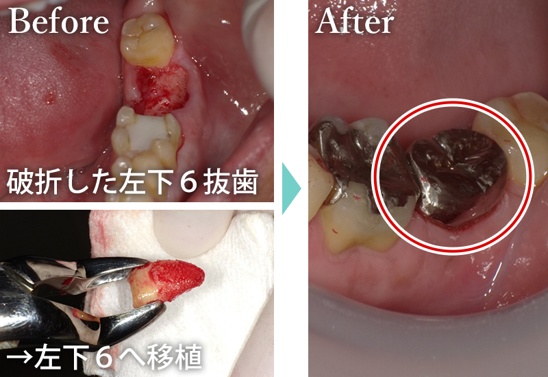自家歯牙移植の症例2