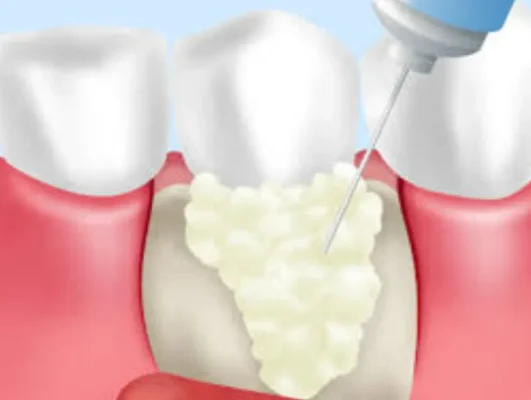 歯周組織再生療法の術式イラスト