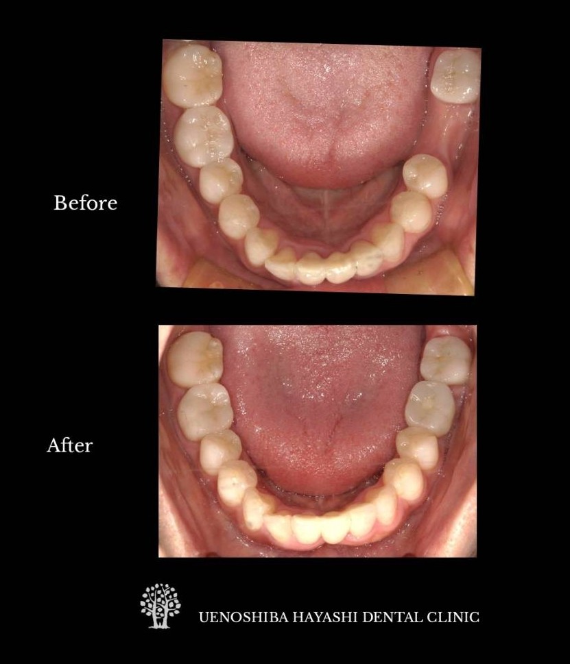上野芝はやし歯科　インプラント治療の症例写真