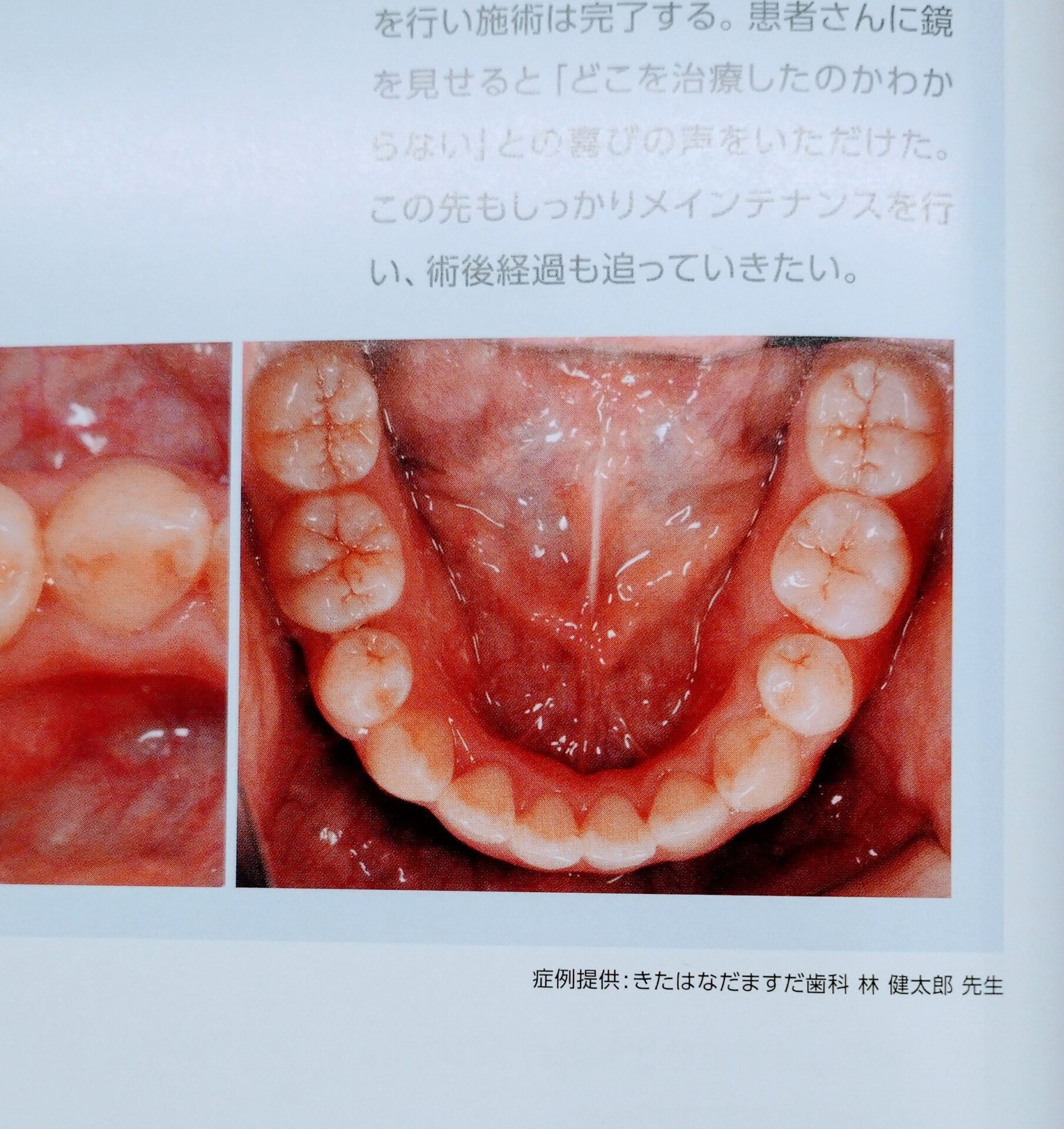 歯科雑誌へ掲載されたセラミック症例