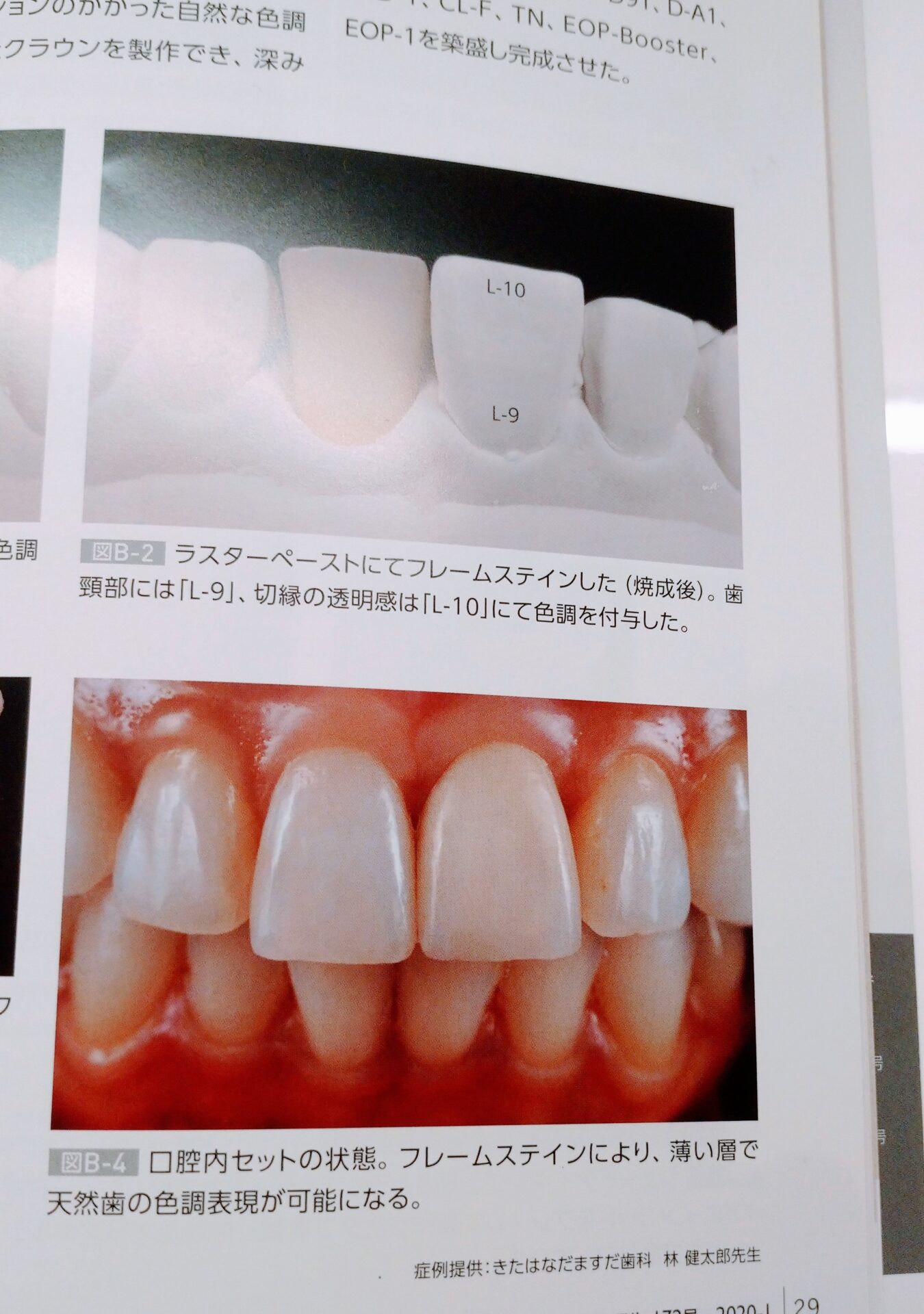 歯科雑誌に掲載されたセラミック症例