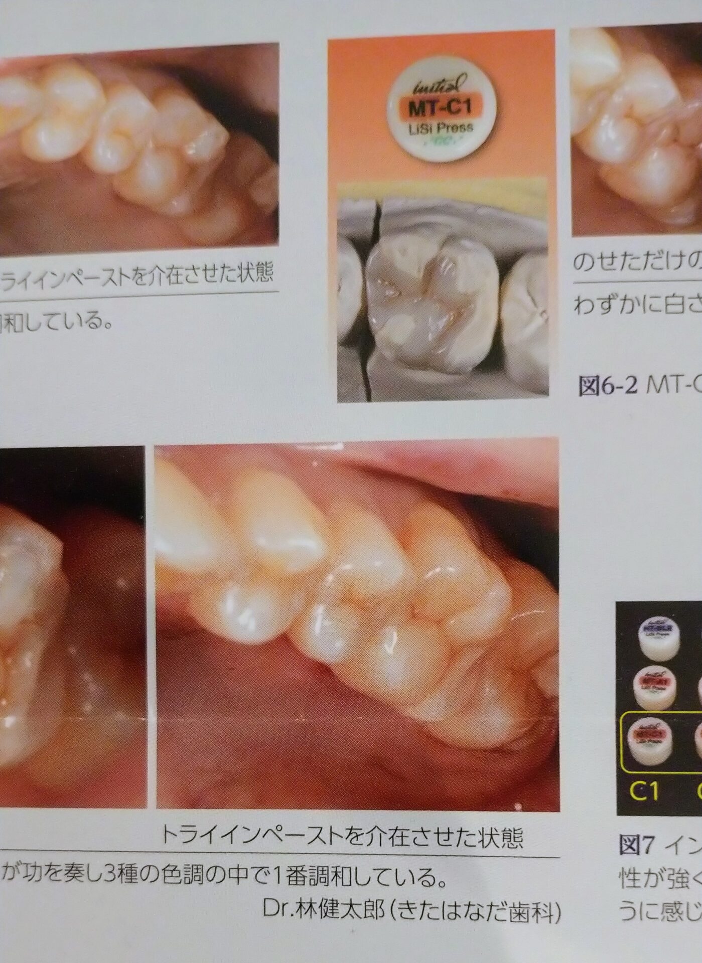歯科専門誌の中のセラミックインレーの掲載症例