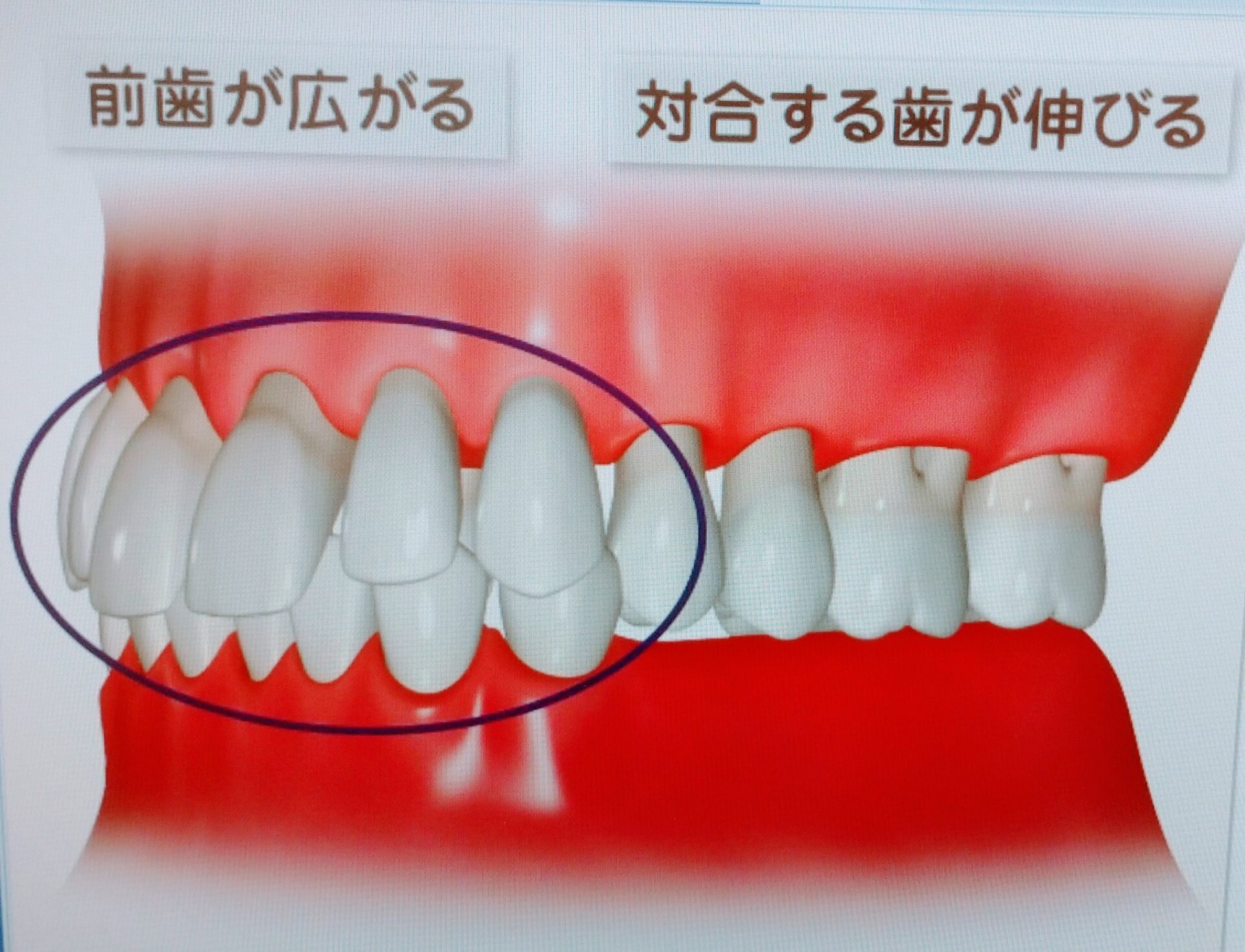 対合歯の挺出と前歯部のフレアアウトがおこっているイラスト