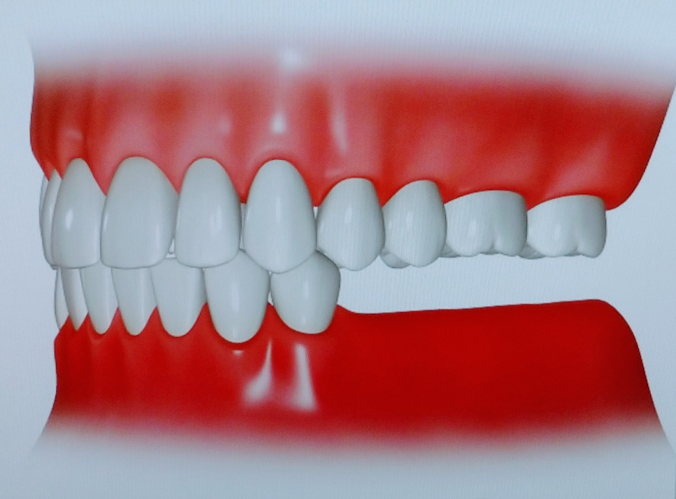 下顎の臼歯部歯牙が欠損している状態のイラスト