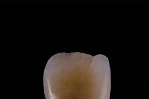 天然歯の切端