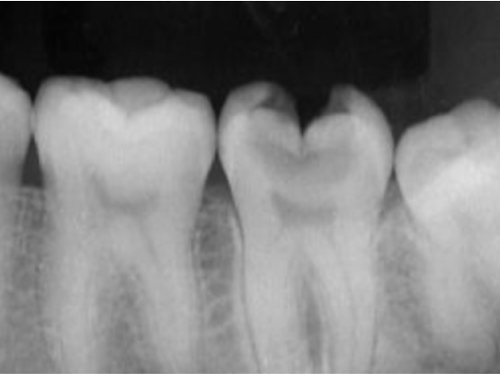虫歯の進行がみられるレントゲン写真