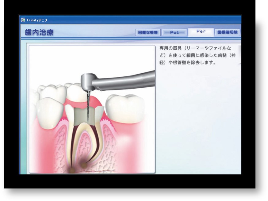 歯科治療の治療内容説明用のアニメーション