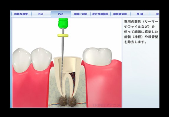 歯科治療の治療説明用のアニメーション