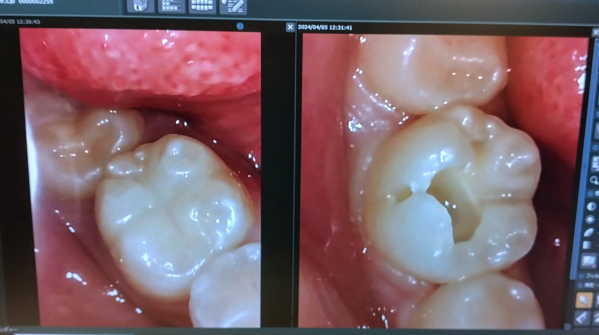 治療後と治療中の口腔内カメラで撮影した画像