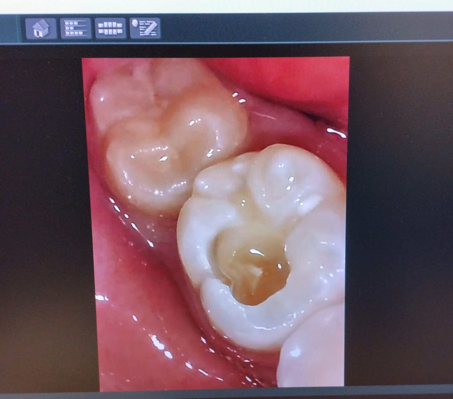 モニターに映し出された虫歯を取っている途中の口腔内カメラの画像