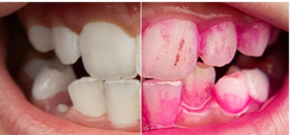 染色液による歯垢の染め出しの比較