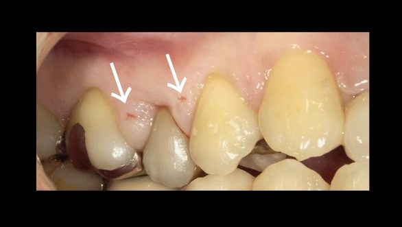 歯周病による歯間部の歯肉増殖