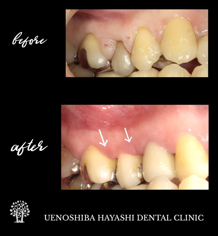 歯周外科治療の症例
