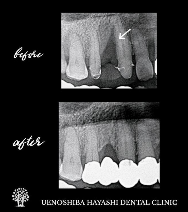 歯周組織再生療法のレントゲン画像