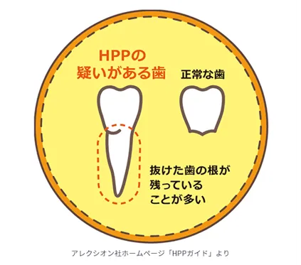 HPPの疑いのある歯