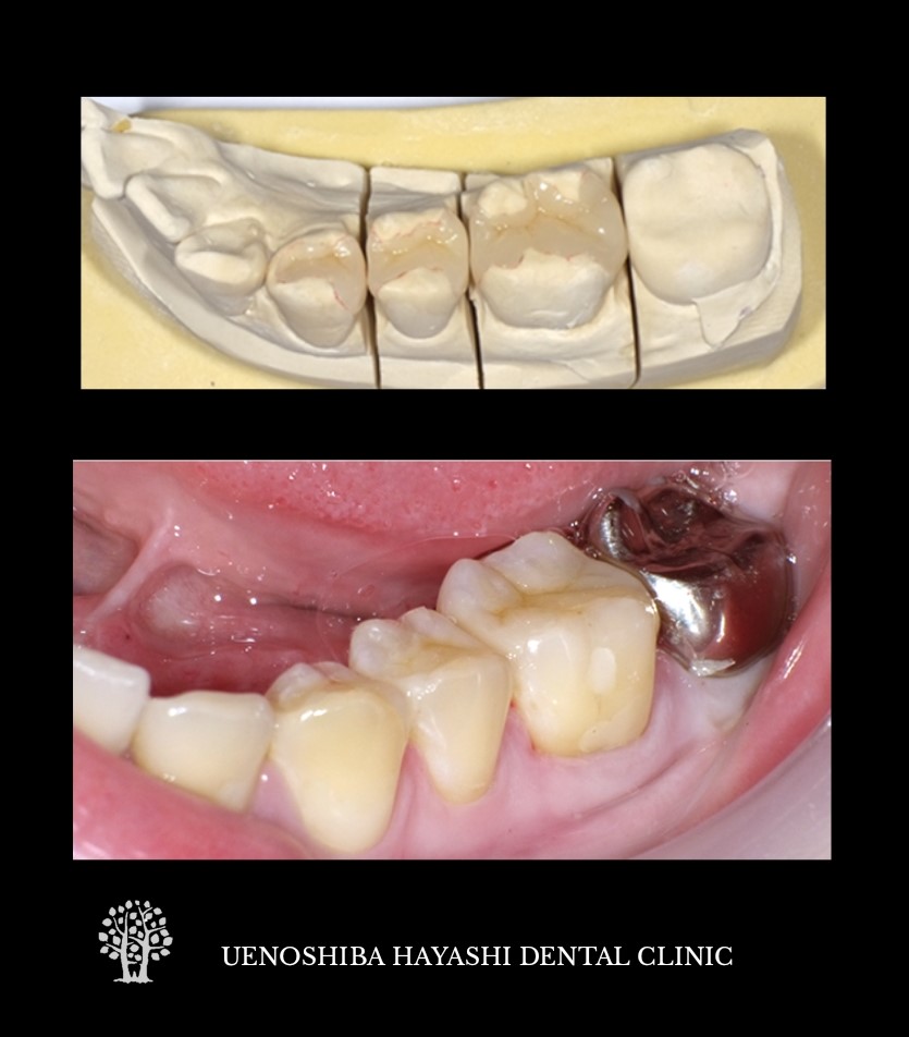 上野芝はやし歯科のセラミックインレーの治療例