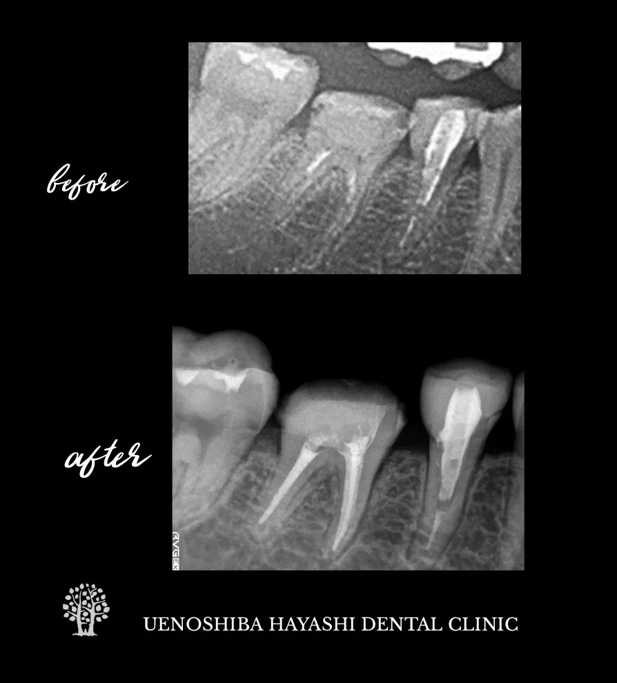 歯内療法症例　上野芝はやし歯科
