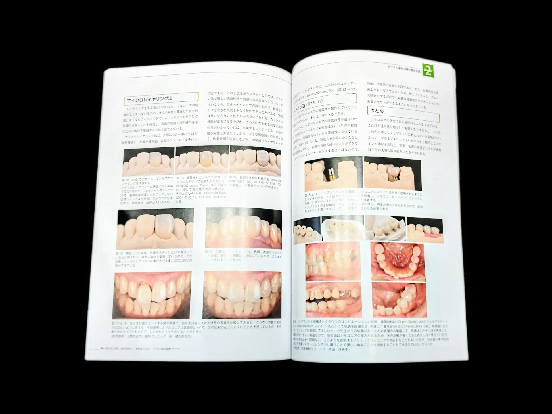 歯科技工専門誌に掲載されたセラミッククラウンの症例写真