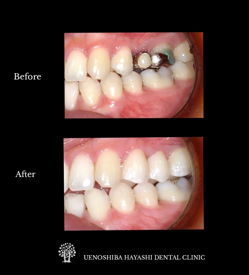 上野芝はやし歯科　セラミック治療症例