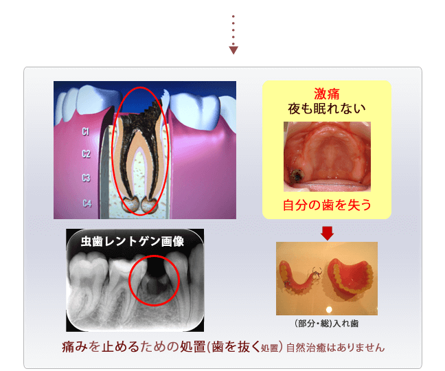 虫歯進行過程3