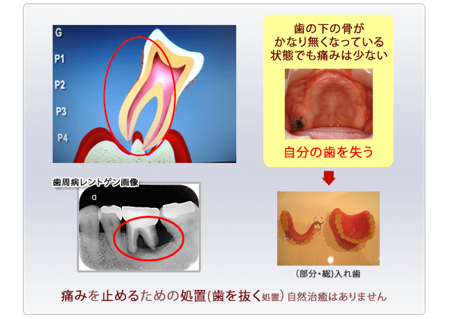 歯周病の進行過程3